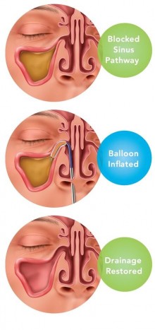 Balloon Sinuplasty Athens GA