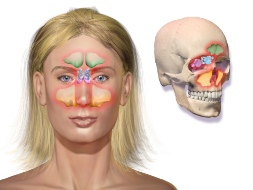 What is Sinusitis? - What is Sinusitis?